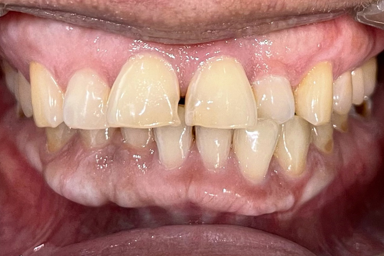 Before Invisalign Treatment